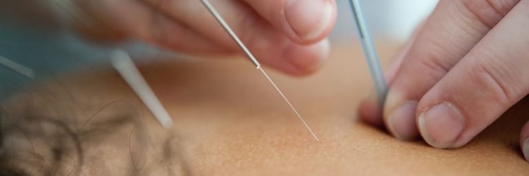 does medicare cover acupuncture